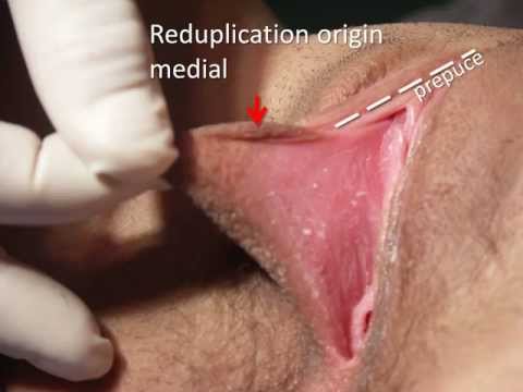 Cosmetic Vaginal Surgery Overview 2013