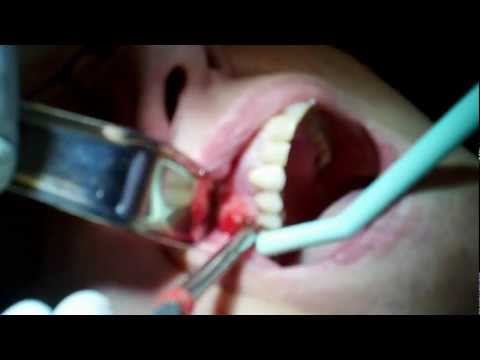 Tigard Dentist pops my enormous abscess.