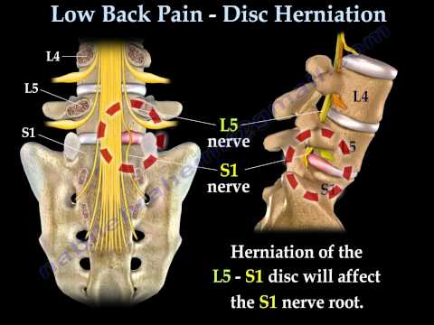 Minimal Again Soreness – Disc Herniation ,Sciatica – Almost everything You Want To Know – Dr. Nabil Ebraheim