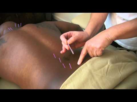 ACUPUNCTURE FOR PSOAS TIGHTNESS!