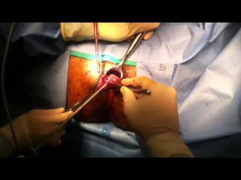 Hemorrhoids | Surgical Removal With Harmonic Scalpel