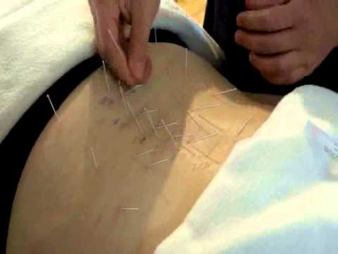 Acupuncture for Sciatica http://www.taiji.net/ppdvd.html